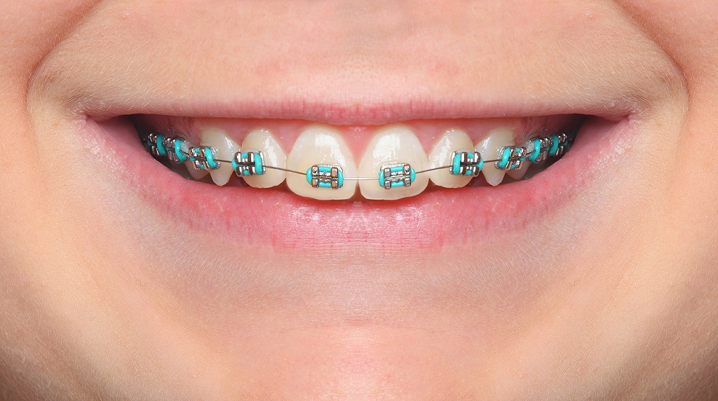 5 Things to Know Before You Visit the Orthodontist