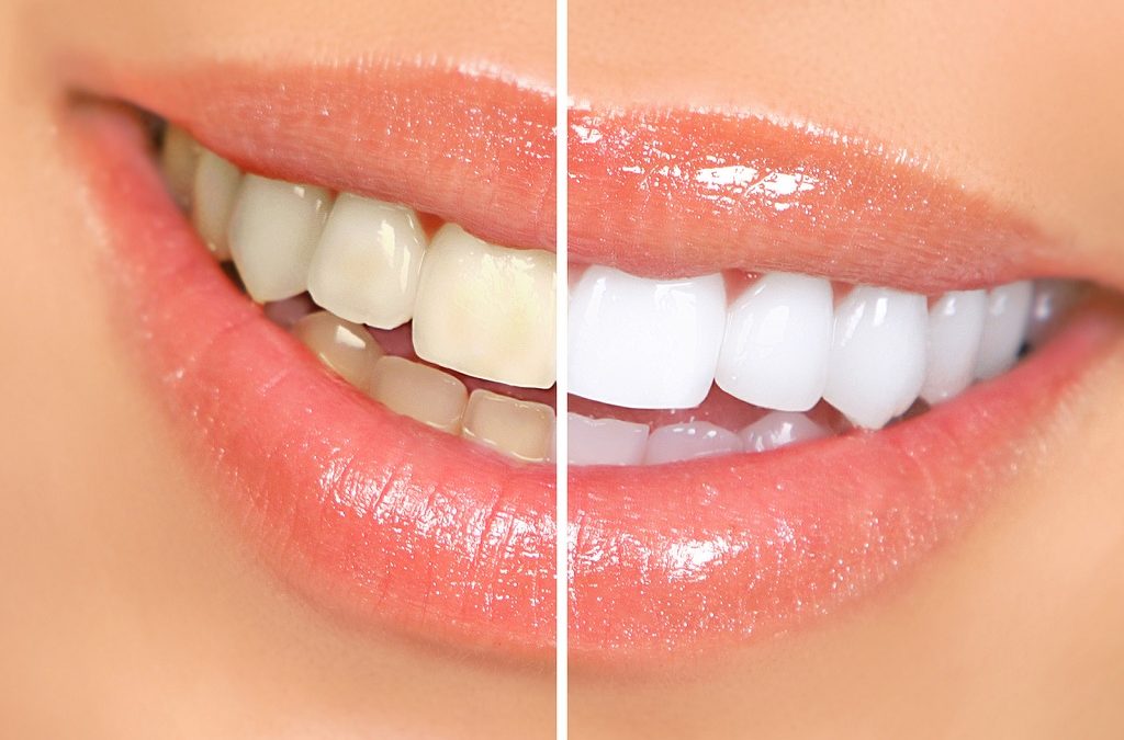 How to Whiten Teeth at Home