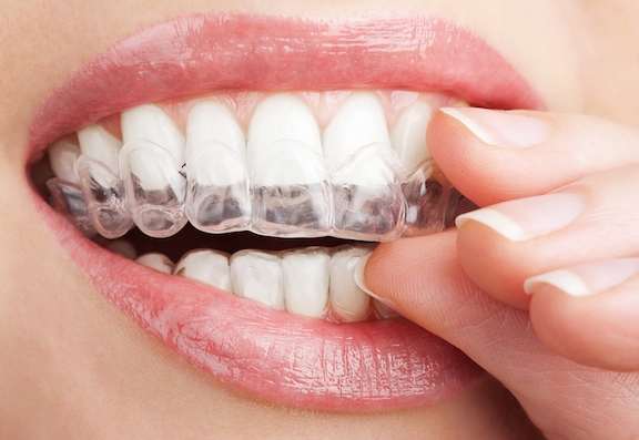 invisalign for adults in geneseo ny