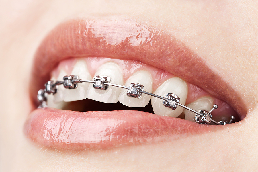 What Is Considered an Orthodontic Emergency?