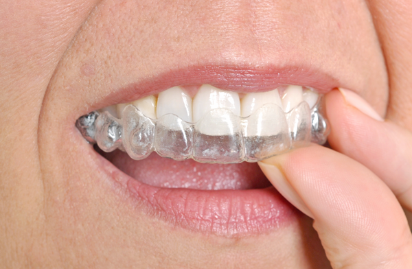 How To Make Your Invisalign Treatment Quick and Easy in Geneseo, NY