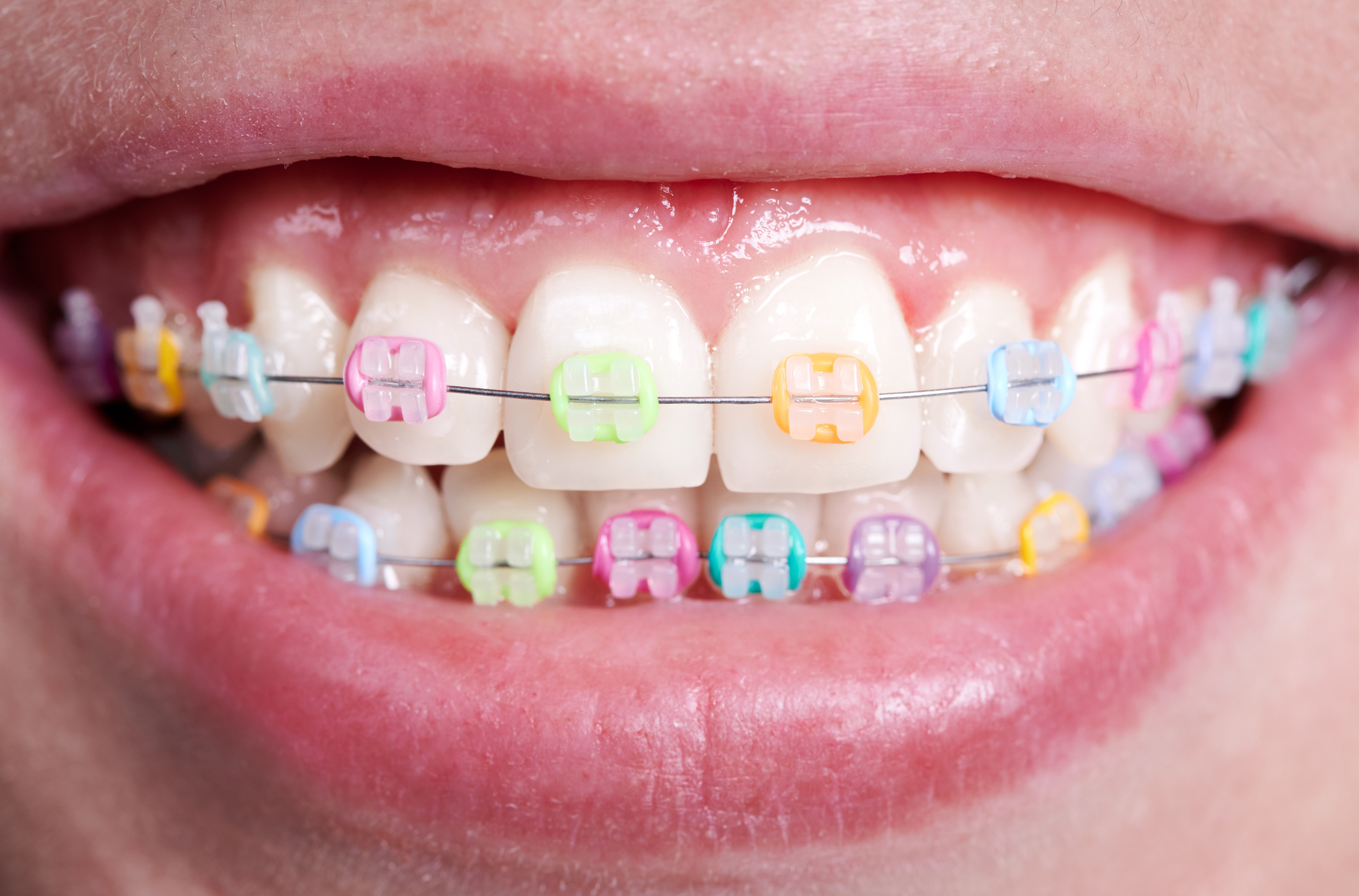 Ceramic Braces: Are They Right For You? Artistic Dental at the