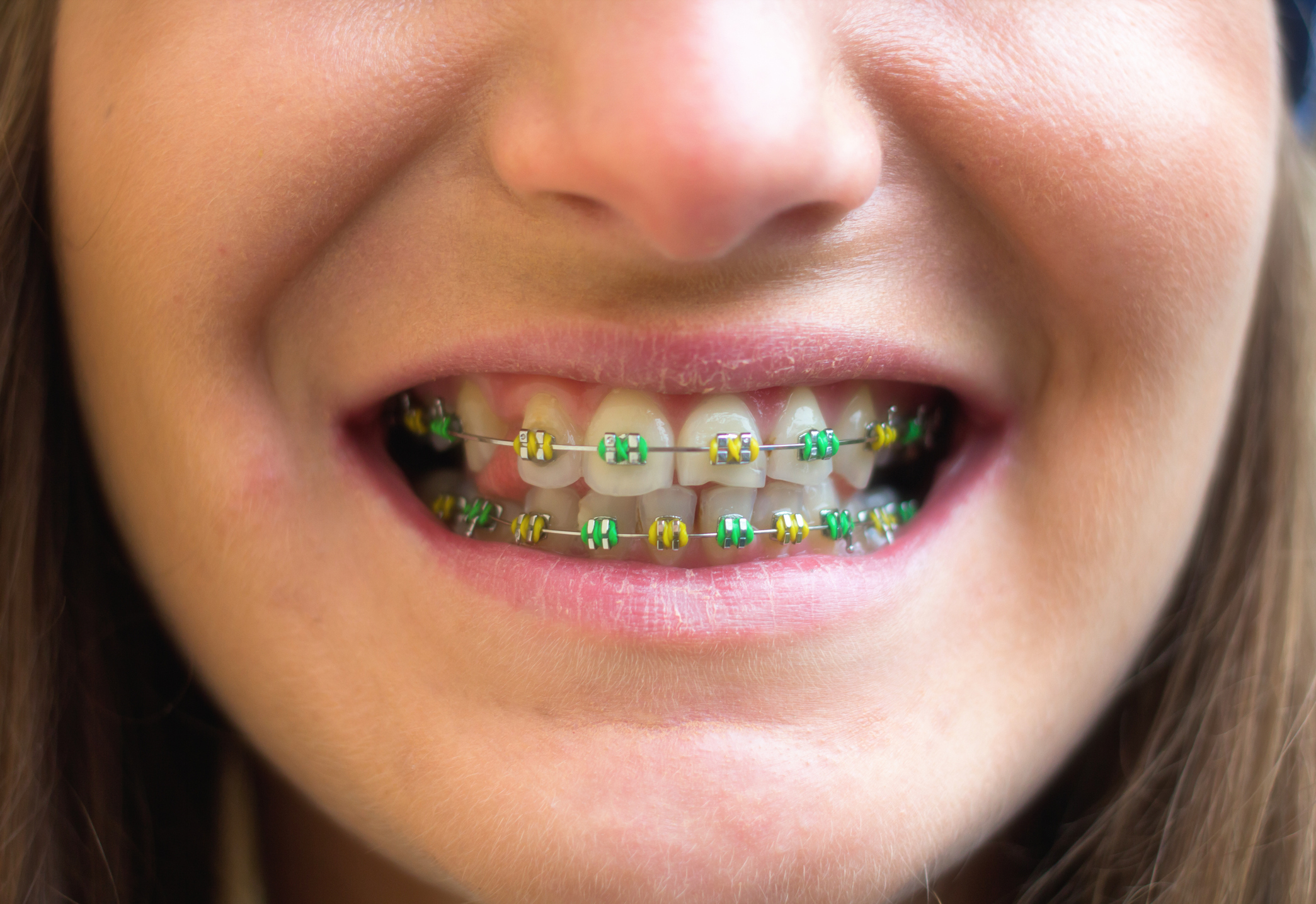 What Your Braces Rubber Band Color Says About You - Orthodontist Waterville  Augusta ME Invisalign Braces
