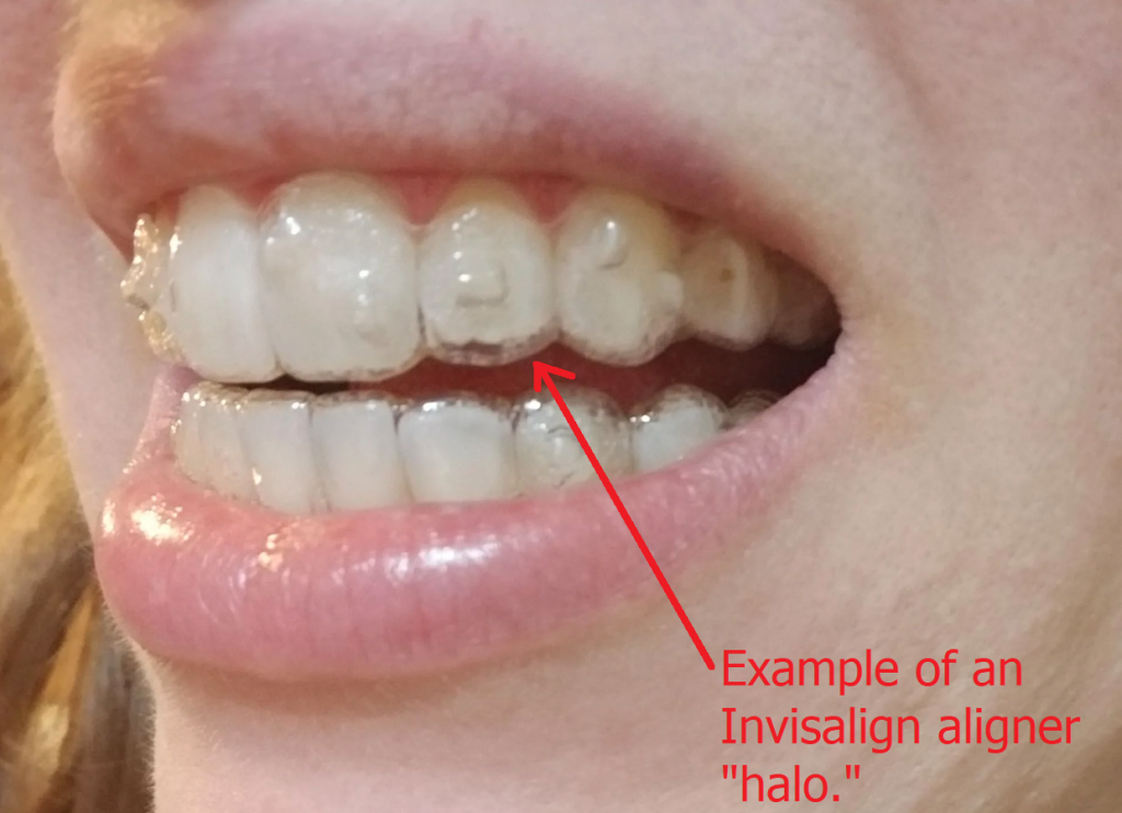 How Do I Know If My Invisalign Clear Aligners are Tracking?