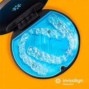 Keeping Your Invisalign Treatment “On Track”