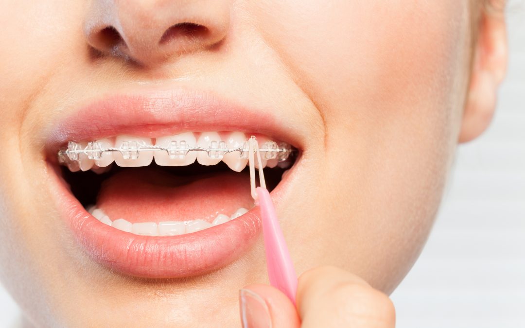 All Things Elastics: A Primer on Orthodontic Elastic Bands