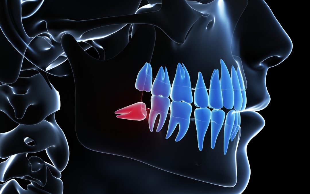 Do Wisdom Teeth Affect Braces?